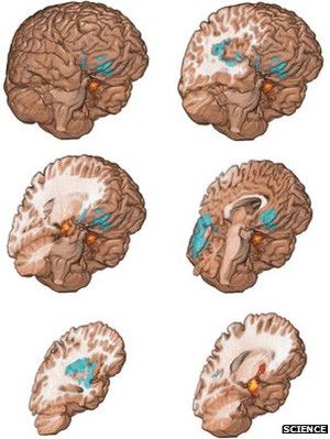 麻薬中毒患者と中毒ではないその兄弟の脳構造を調査したところ、同じような脳障害が存在していることが判明したという話である